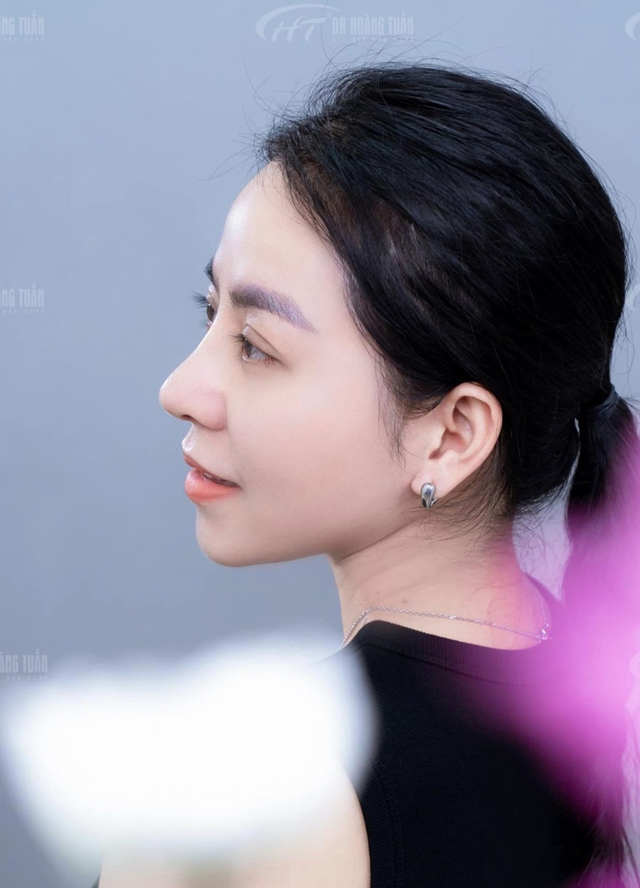 Chọn các loại sụn nâng mũi sẽ giúp bạn có được dáng mũi như ý